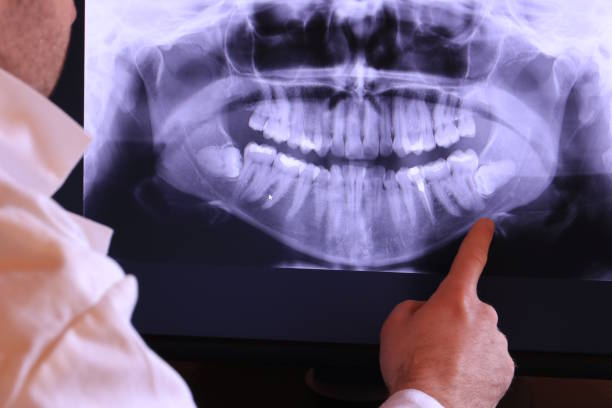 Best Dental Abscess Treatment in Alpharetta, GA